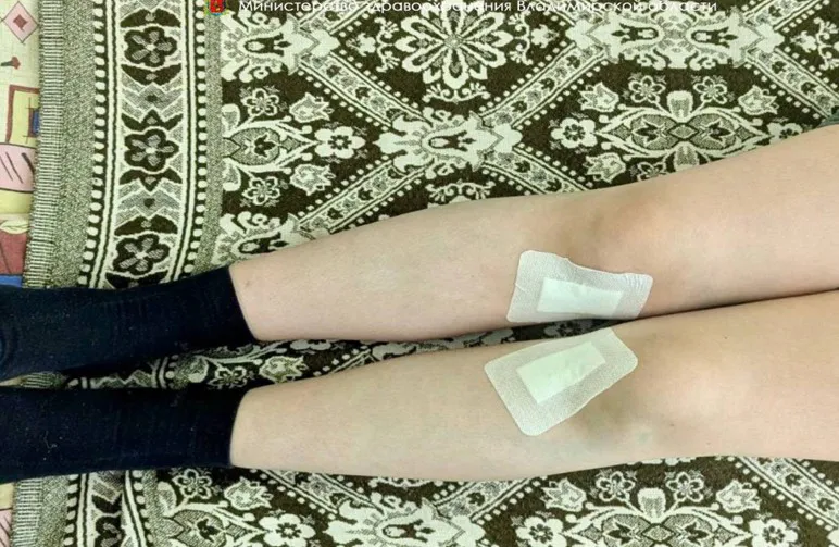Владимирские врачи исправили тяжелую деформацию ног у 13-летнего мальчика